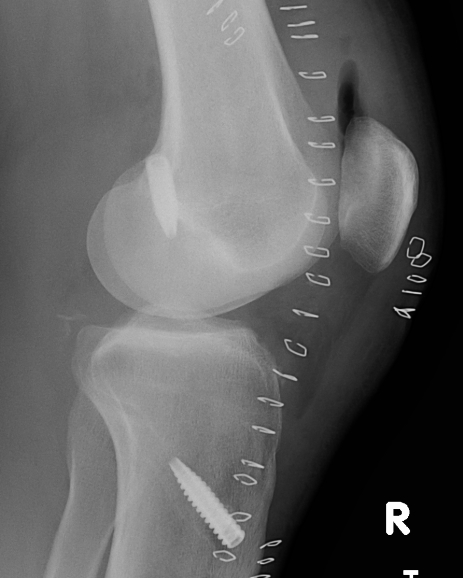 PCL Lars Lateral